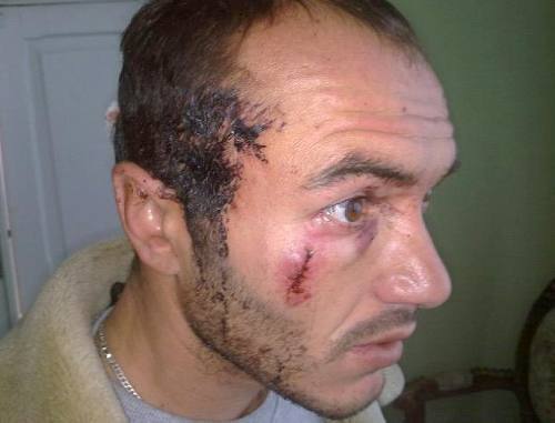 Сторонник Аллы Джиоевой, Дмитрий Собаев, избитый неизвестными по дороге в Цхинвал. Фото: uasamonga.ru
