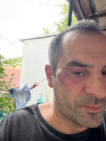 Селфи Ванико Тархнишвили после нападения. Скриншот из телеграм-канала Tbilisi life. https://t.me/Tbilisi_life/40654