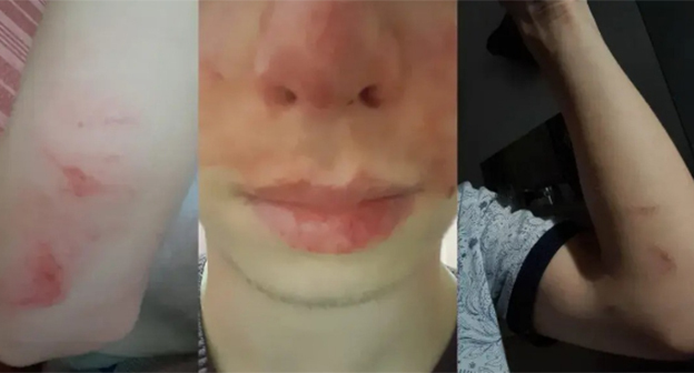 Следы побоев у подростка. Скриншот видео "Кавказского узла" https://www.instagram.com/p/DLo13qas84B/ принадлежит компании Meta деятельность которой запрещена в России Следы побоев у подростка. Скриншот видео "Кавказского узла" https://www.instagram.com/p/DLo13qas84B/ принадлежит компании Meta деятельность которой запрещена в России